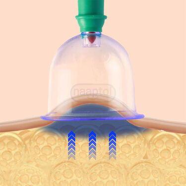 Cupping Therapy For Pain Relief (CT02)