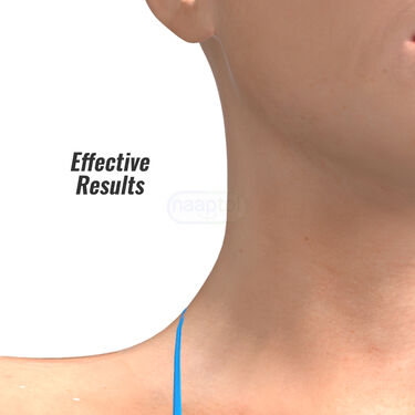 Painless Massa Remover Kit (WR3)