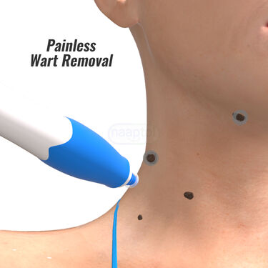 Painless Massa Remover Kit (WR3)