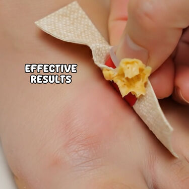 Wart & Corn Remover Pads 24 Pieces (CD-WR)