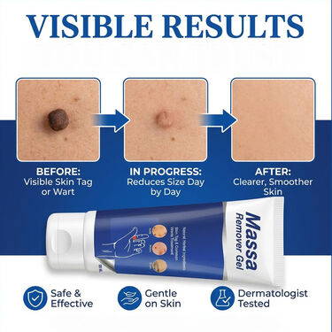 Massa Remover Gel (BCMR)