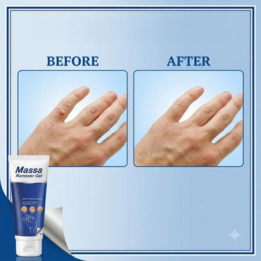 Massa Remover Gel (BCMR)