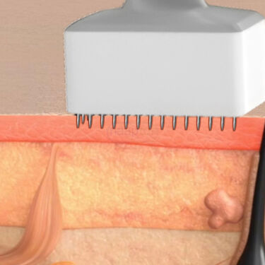 Adjustable Derma Stamp For Hair & Beard Growth Support (DR1)