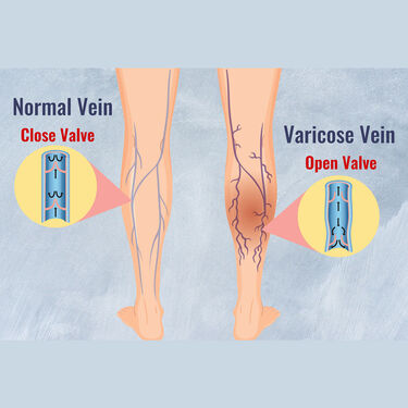 Varicose Spray with Pain Relief Compression Socks (PRS33)